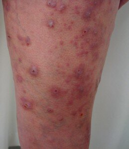 Keloid