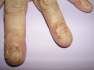 Kynsipsoriasis